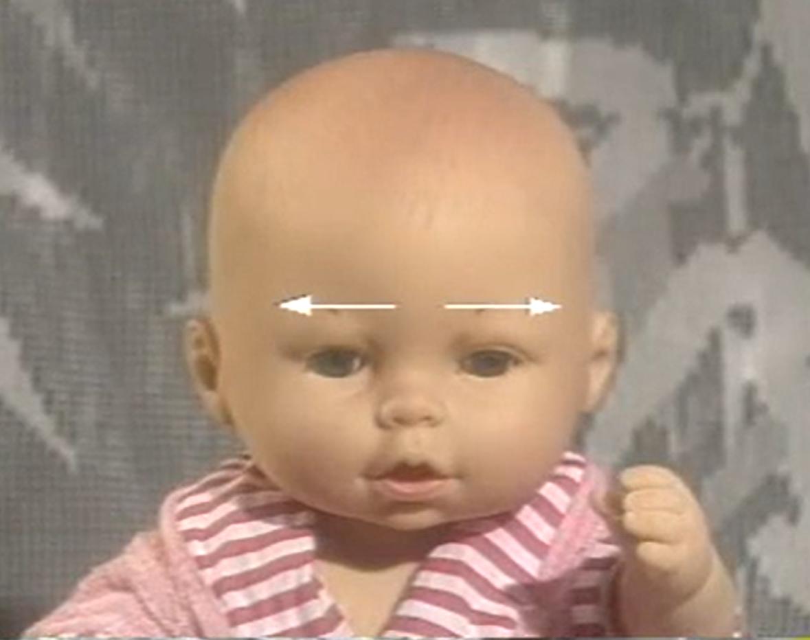 发热穴位小儿推拿,发热的小儿推拿退烧手法