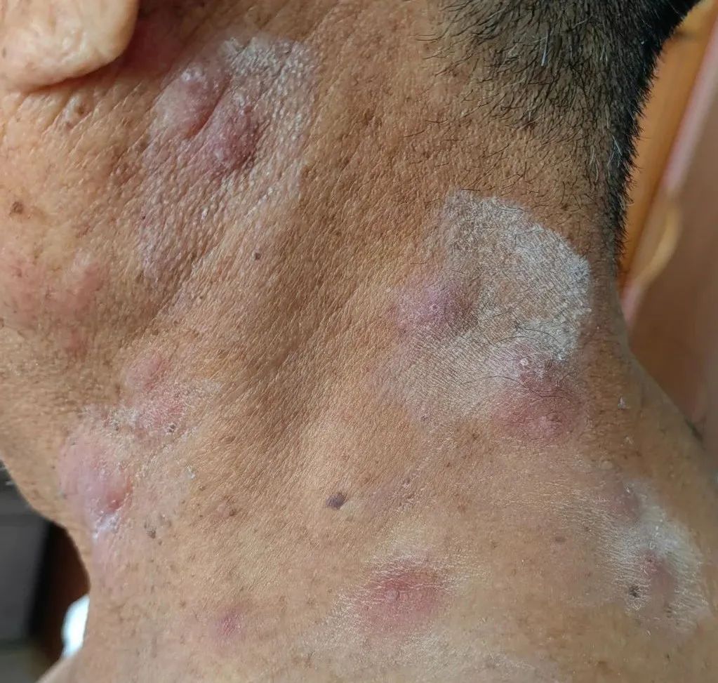 带状疱疹,20元能搞定吗?