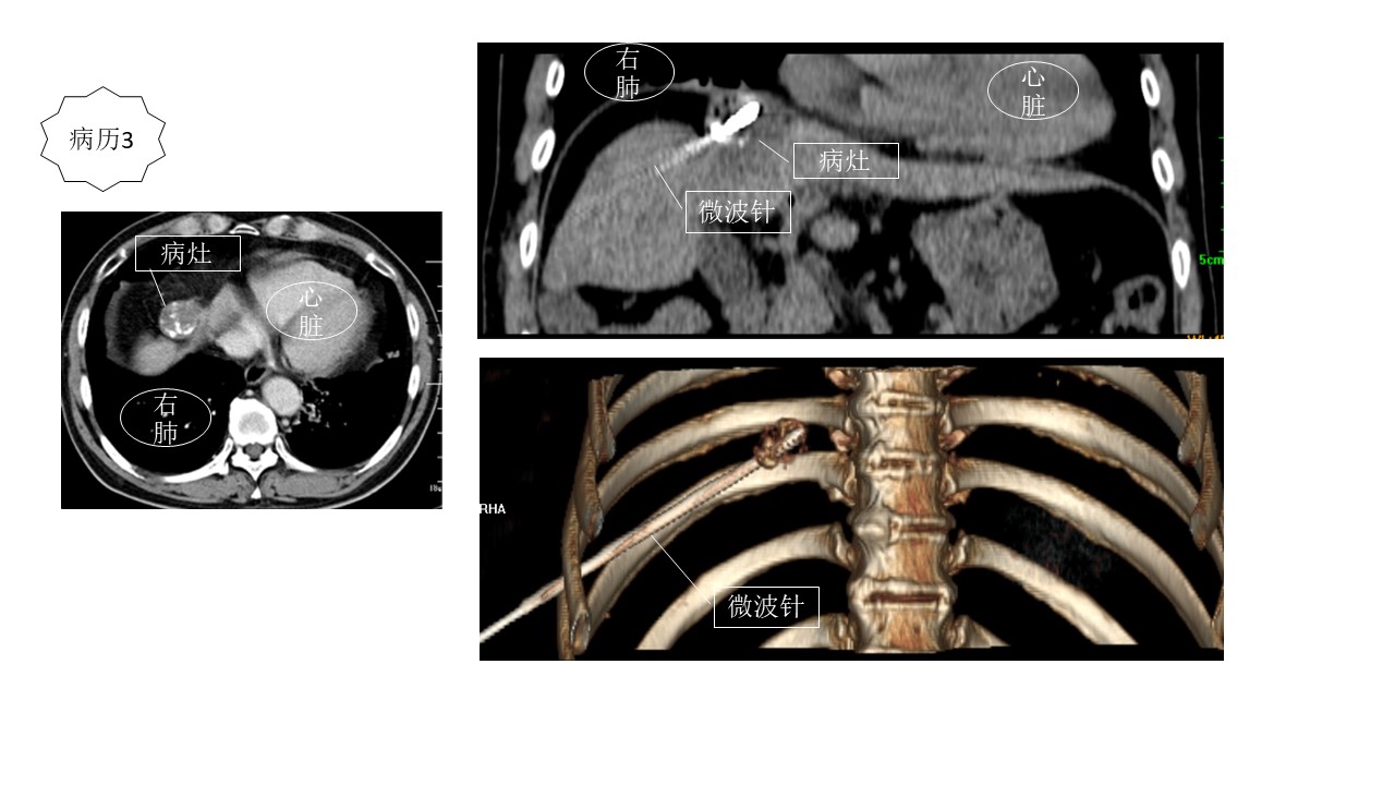 肿瘤局部消融的病历举例