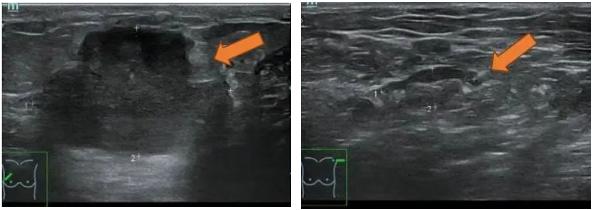 抗her2阳性治疗,双靶向治疗her2复发率