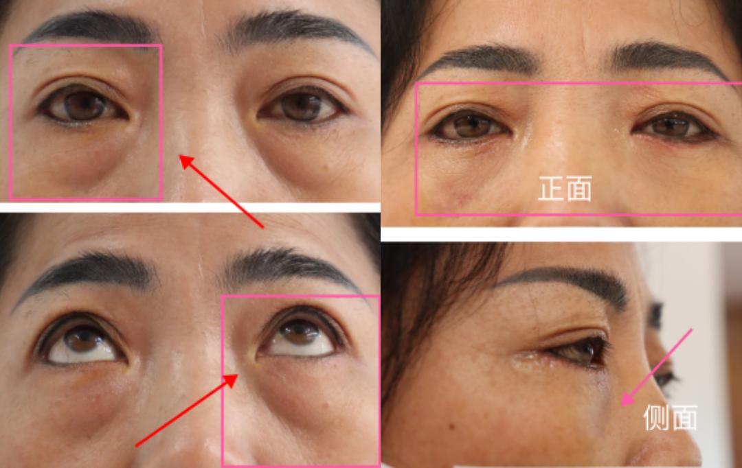 眼袋也分真假你能分辨的出来吗,眼袋卧蚕傻傻分不清楚