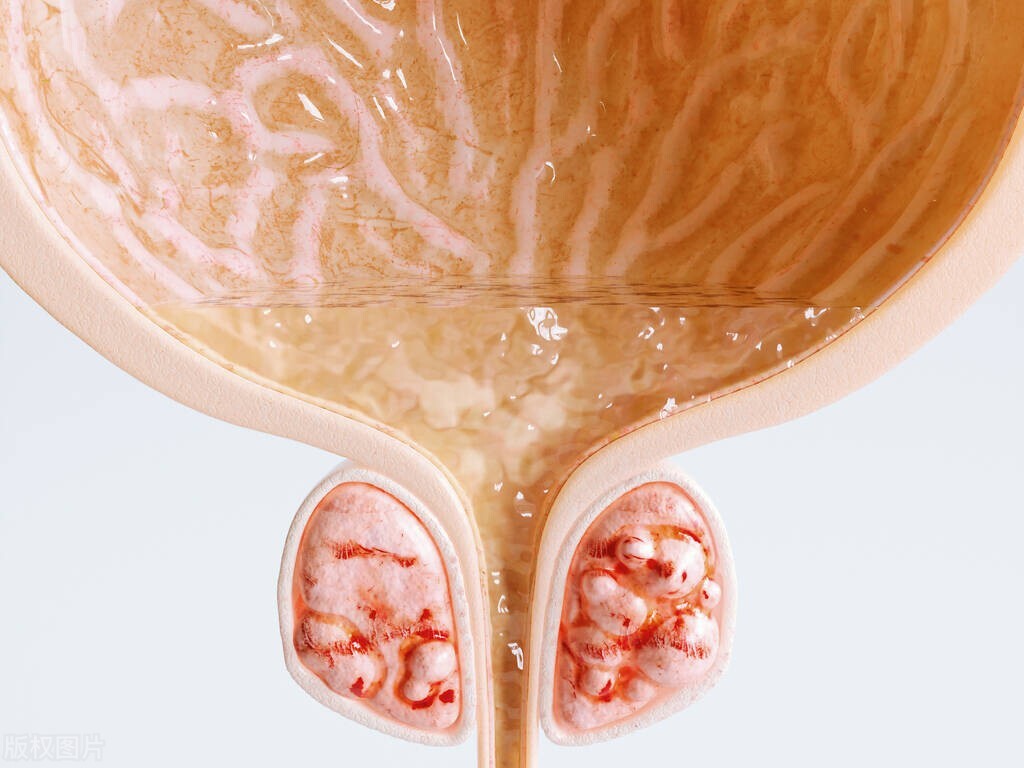 漏尿女性应该用什么药,漏尿是怎样的难言之隐