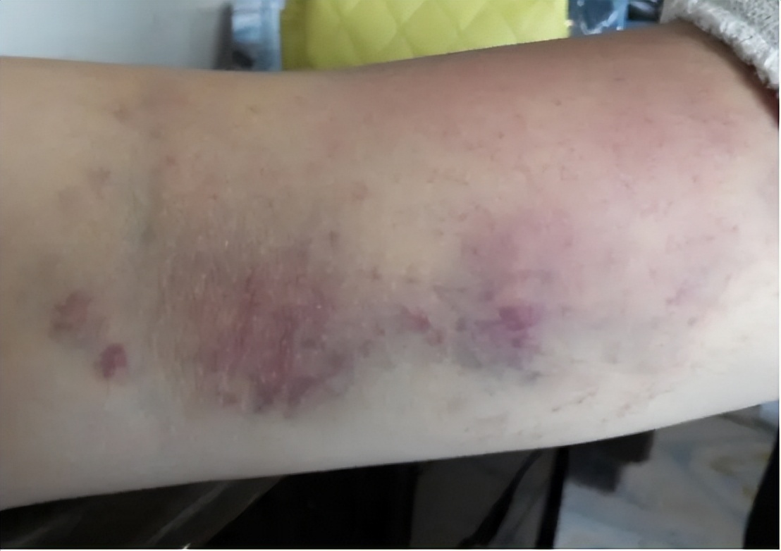 筋膜提升的副作用和危害,筋膜枪危害图片大全