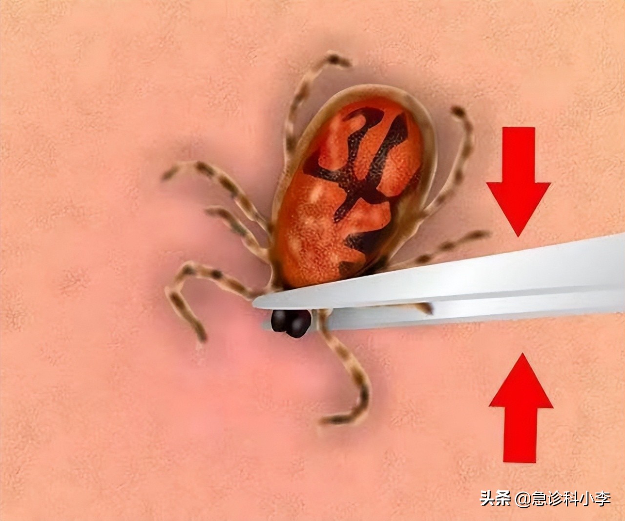 夺命蜱虫咬了是什么样子,夺命蜱虫一家三口被咬两人丧命