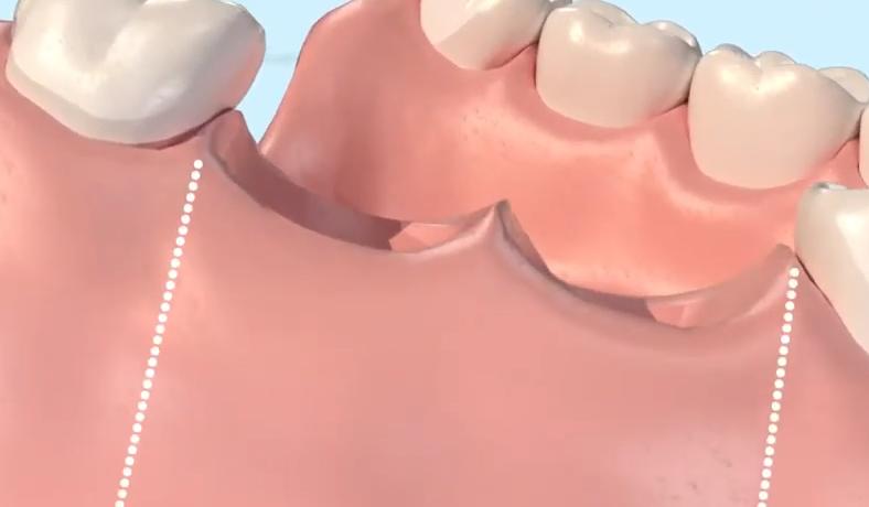 拔牙坑里面会有食物残渣怎么办,拔牙以后那个坑怎么清洁