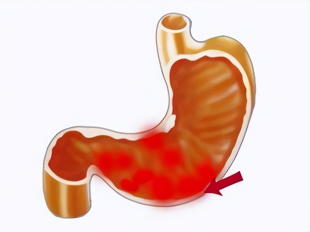 胃穿孔的症状及治疗方法,胃穿孔什么治疗方法好