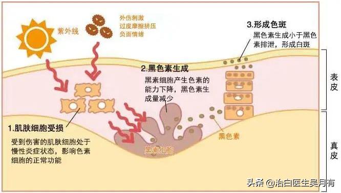 外伤导致白癜风概率大吗,外伤引起的白癜风照308有效果吗