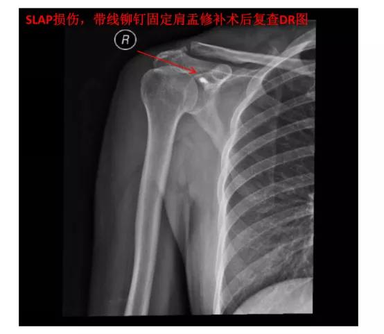 老是肩膀难受咋回事,肩膀痛要怎么缓解