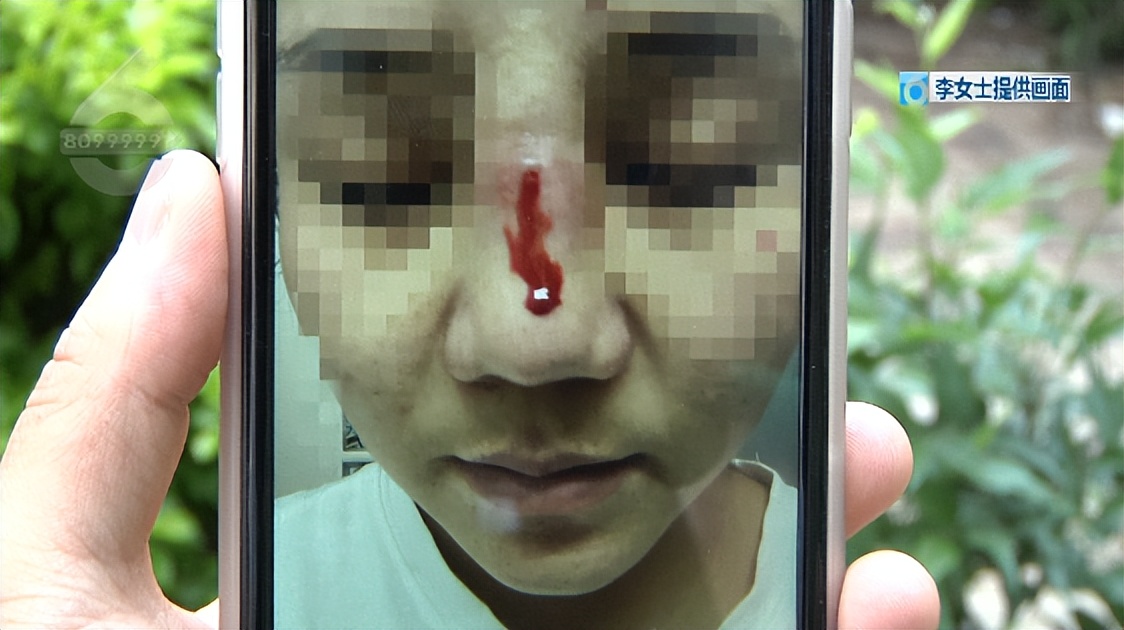 鼻子整形后流脓是不是医疗事故,鼻子整容后流脓怎么处理