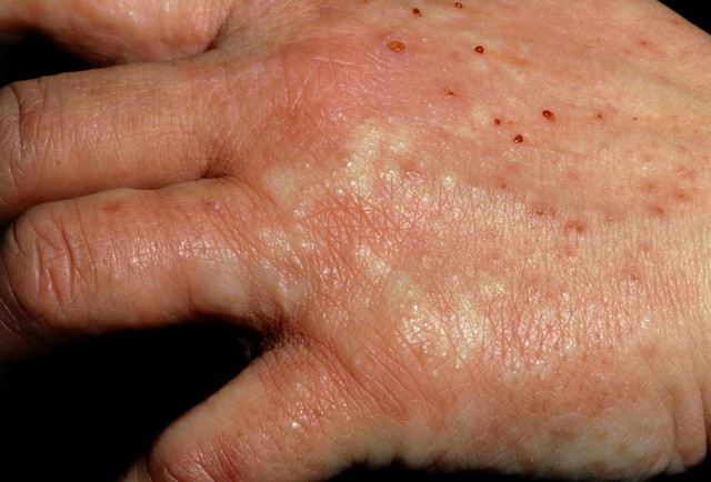 湿疮和湿疹搽什么药,湿疮和湿疹中医该怎么解决