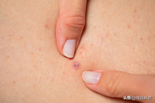 大腿内侧易发毛囊炎,哪些人群更易患毛囊炎呢