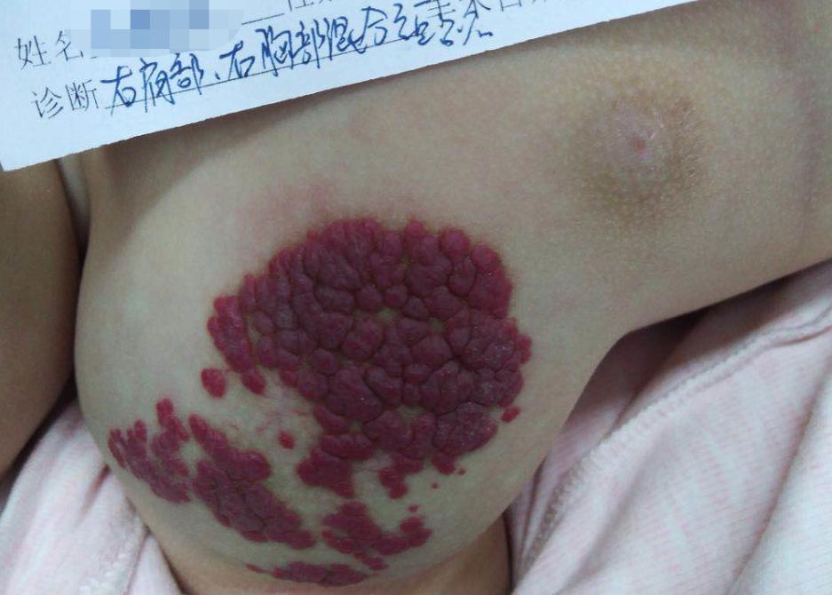 婴幼儿血管瘤会自行消退？小心长在这些部位的“瘤”，或危及生命