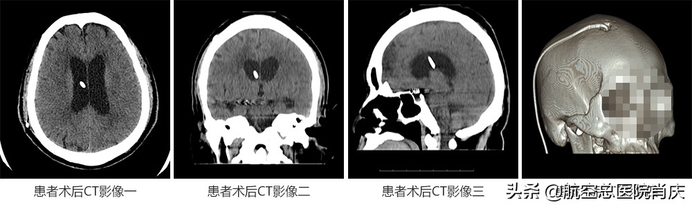 颅内动脉瘤术后继发脑积水合并中枢神经系统感染
