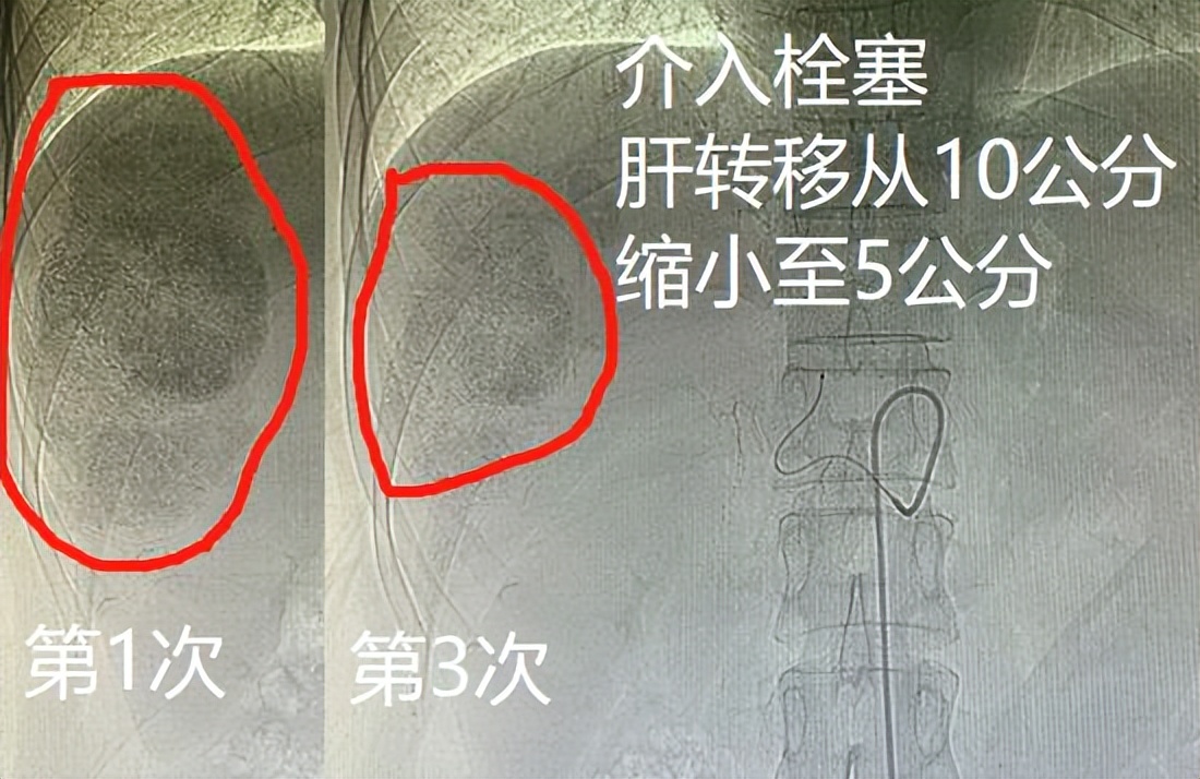 介入栓塞+微波消融：消灭肠癌病人10公分肝转移瘤，无瘤健康过3年