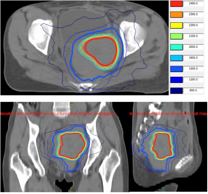 外阴鳞癌放疗后复发还能活多久,宫颈鳞癌化疗后病灶没缩小