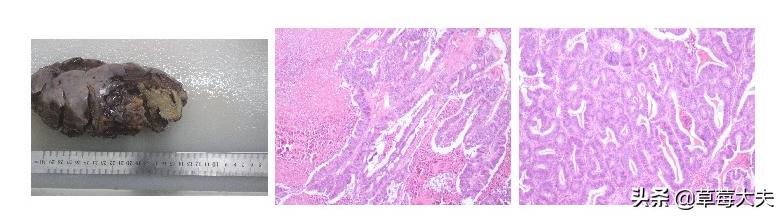 肚子莫名长大！40岁姐姐取出柚子大肿瘤，一查是肠道癌症跑到卵巢