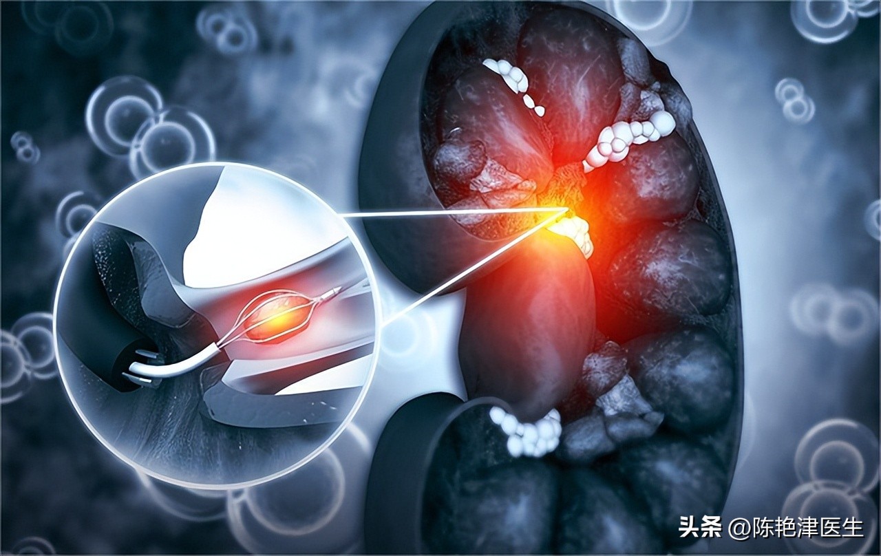 体检查出肾结石怎么办？医生：2个方法，或能让肾结石离开身体