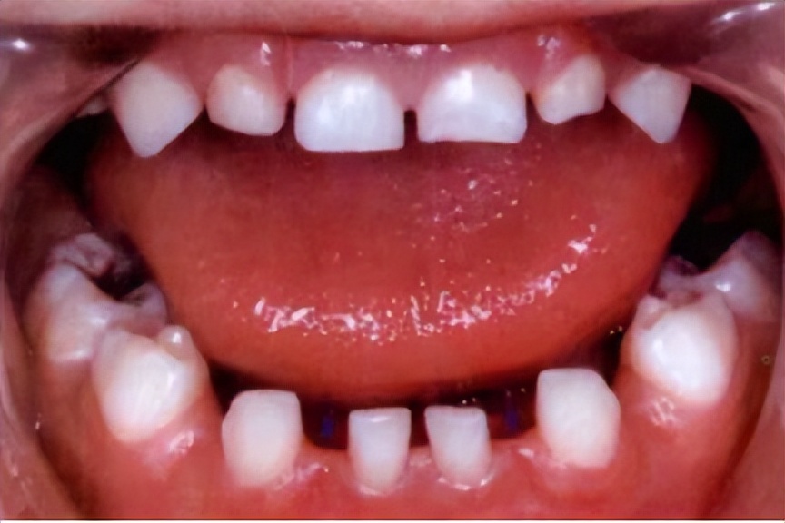 宝宝牙缝有点大这是好还是坏呢,为什么宝宝的牙缝很大