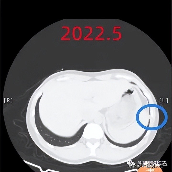 肺部结节医生建议抗炎后复查,放射科医生查出肺结节
