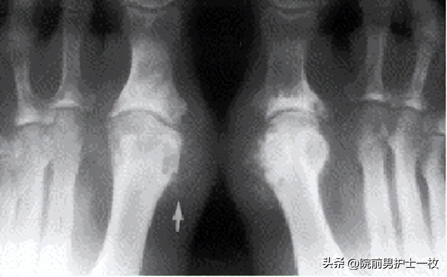 痛风诊治中需要注意哪些问题,痛风的治疗与饮食