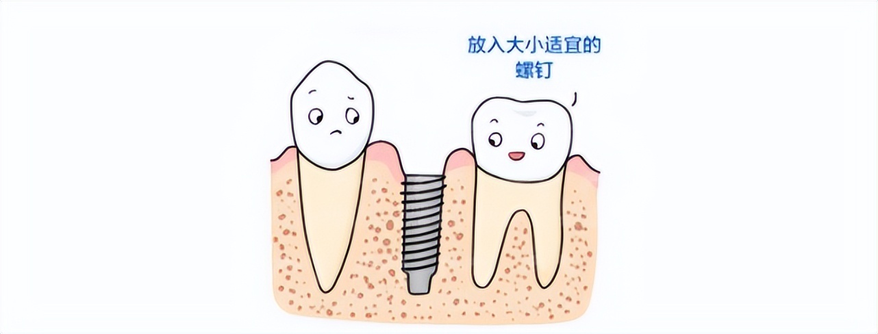 种植牙是怎么种的动画,种植牙是怎么种进去的