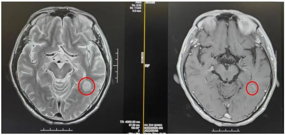 斯鲁利单抗治疗小细胞肺癌生存期,小细胞肺癌3a期用斯鲁利单抗