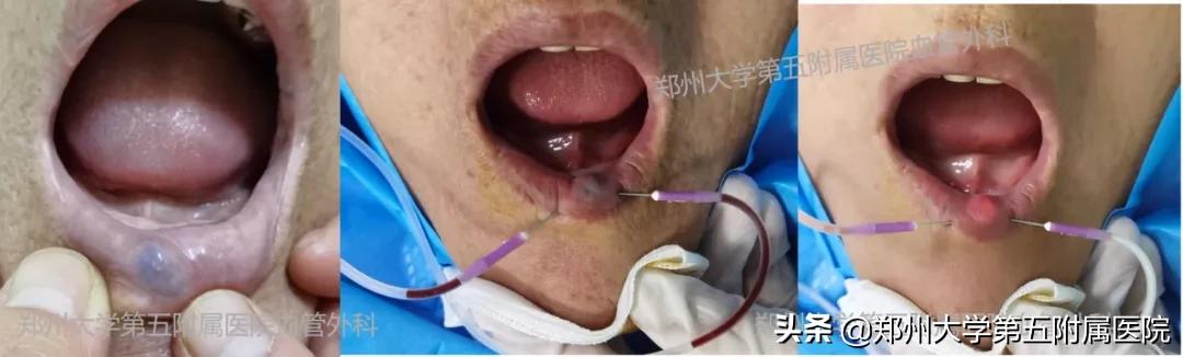 健康科普治疗结节,静脉畸形有硬肿块要做手术吗