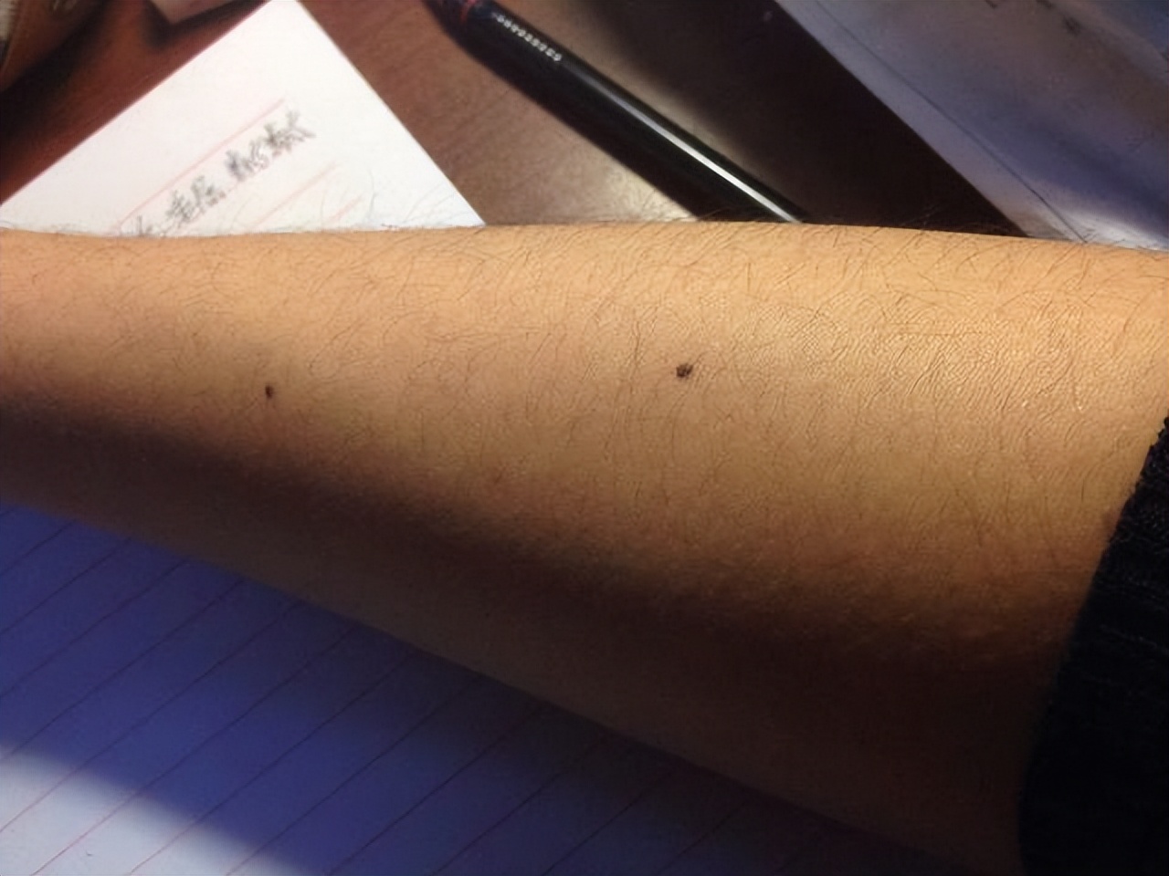 医生如何检查黑痣和黑色素瘤,医生长在摩擦部位的黑痣要当心