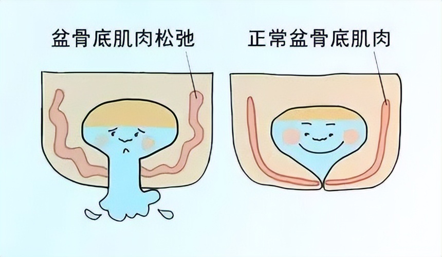 门肌训练,盆底肌医学讲解