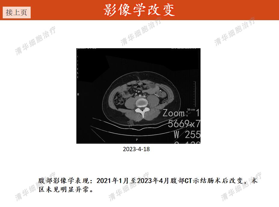 结肠癌术后化疗方案的制定策略,结肠癌手术后热灌注化疗能根治吗