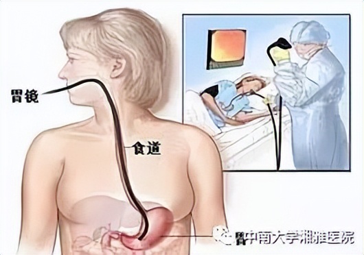 肠胃镜检查正常但肚子老痛,烧心痛必须要做胃镜检查吗