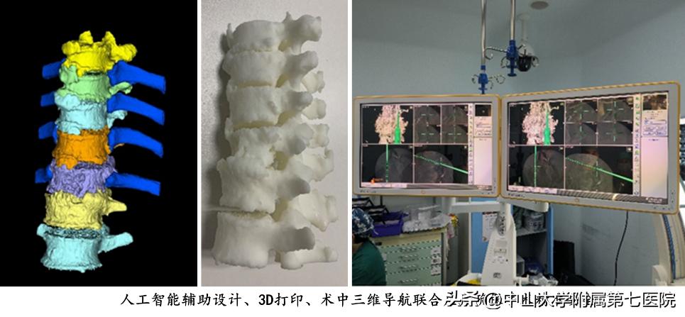 结核病菌“吃空”脊椎致腰痛难忍!人工智能辅助手术一次性解救“生命之柱”