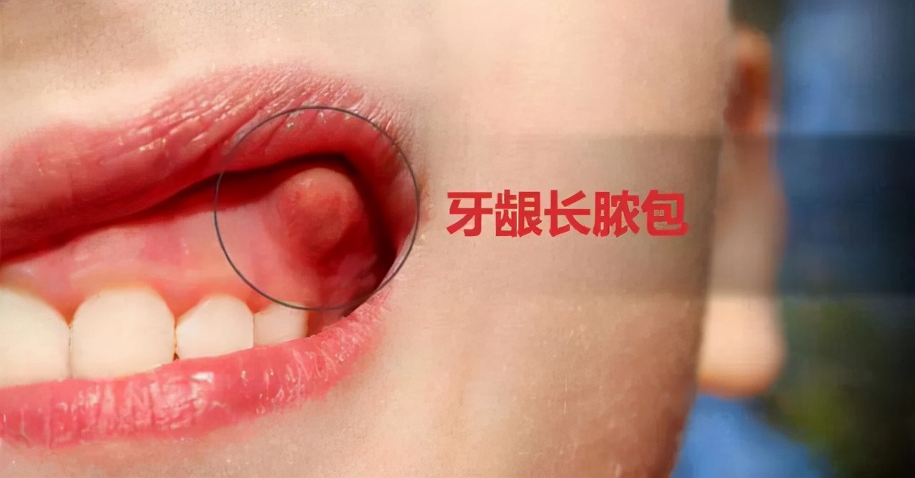 牙龈肿胀鼓包是什么并发症,糖尿病人牙龈肿痛是并发症吗