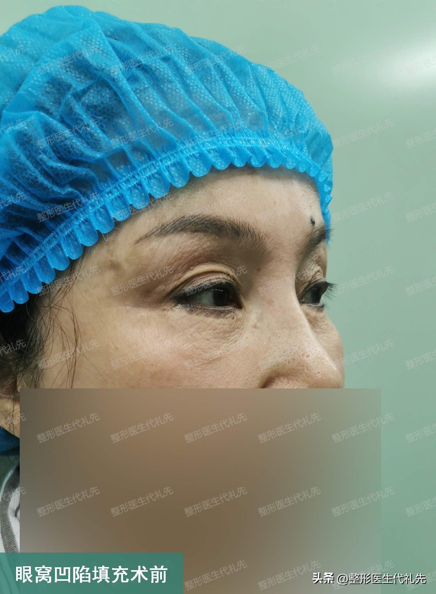 眼窝凹陷睡觉可以恢复吗,长时间熬夜下眼窝凹陷可以恢复吗