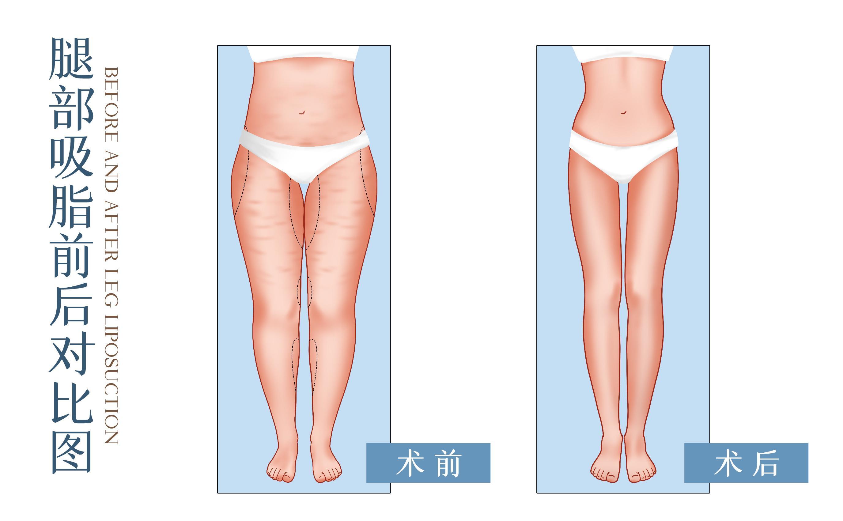 吸脂手术的四大误区,吸脂一般吸哪几个部位