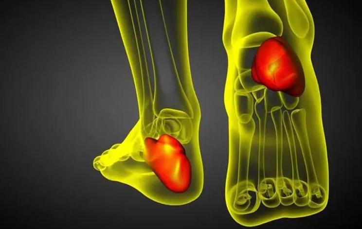 什么是痛风痛风都有哪些表现,什么是痛风痛风的主要症状是什么