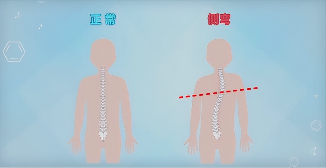 孩子站立老是歪向一边,小孩子坐姿不矫正怎么改正