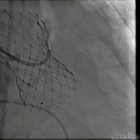 病例回顾与分享,腹膜后血肿介入治疗