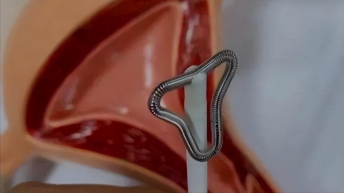 女性取出节育环后多久可以怀孕,节育环在体内有年限吗