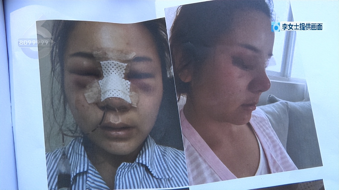 鼻子整形后流脓是不是医疗事故,鼻子整容后流脓怎么处理