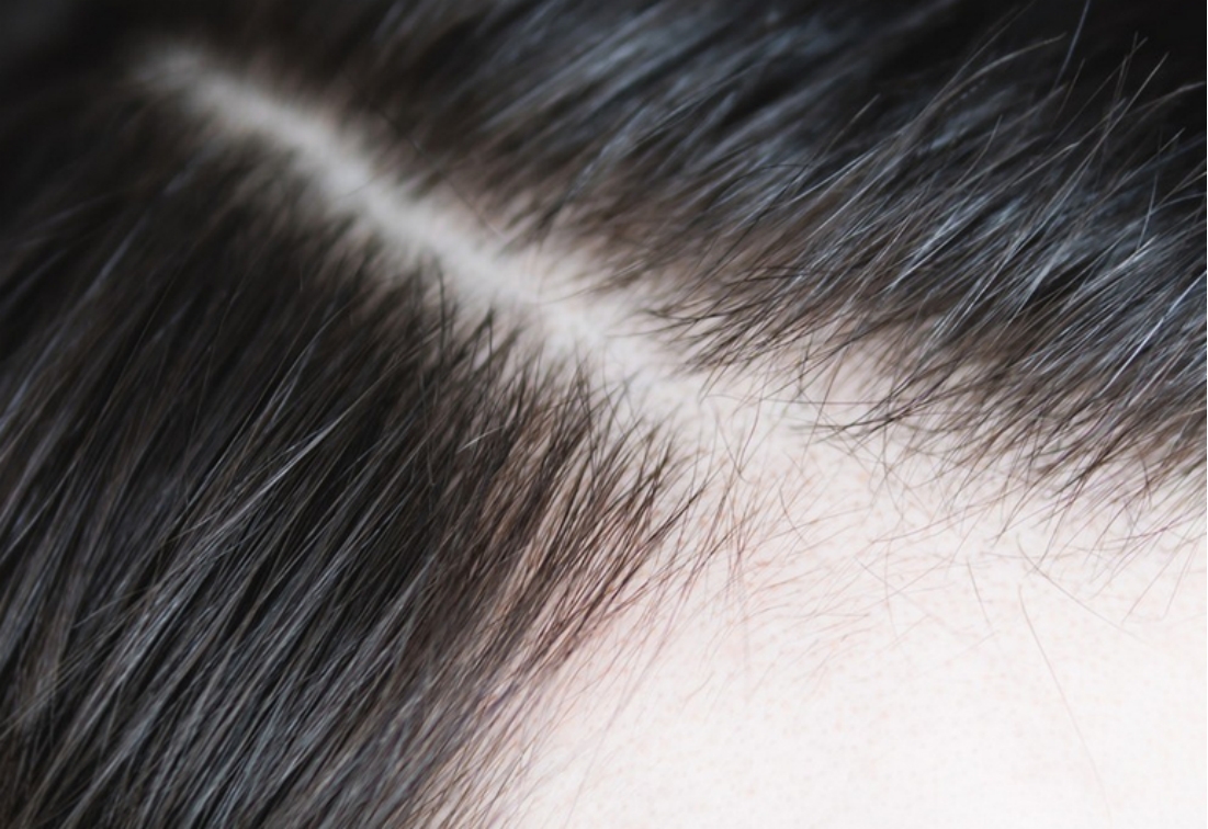 怎么脱发最有效果,怎么样脱发才算严重