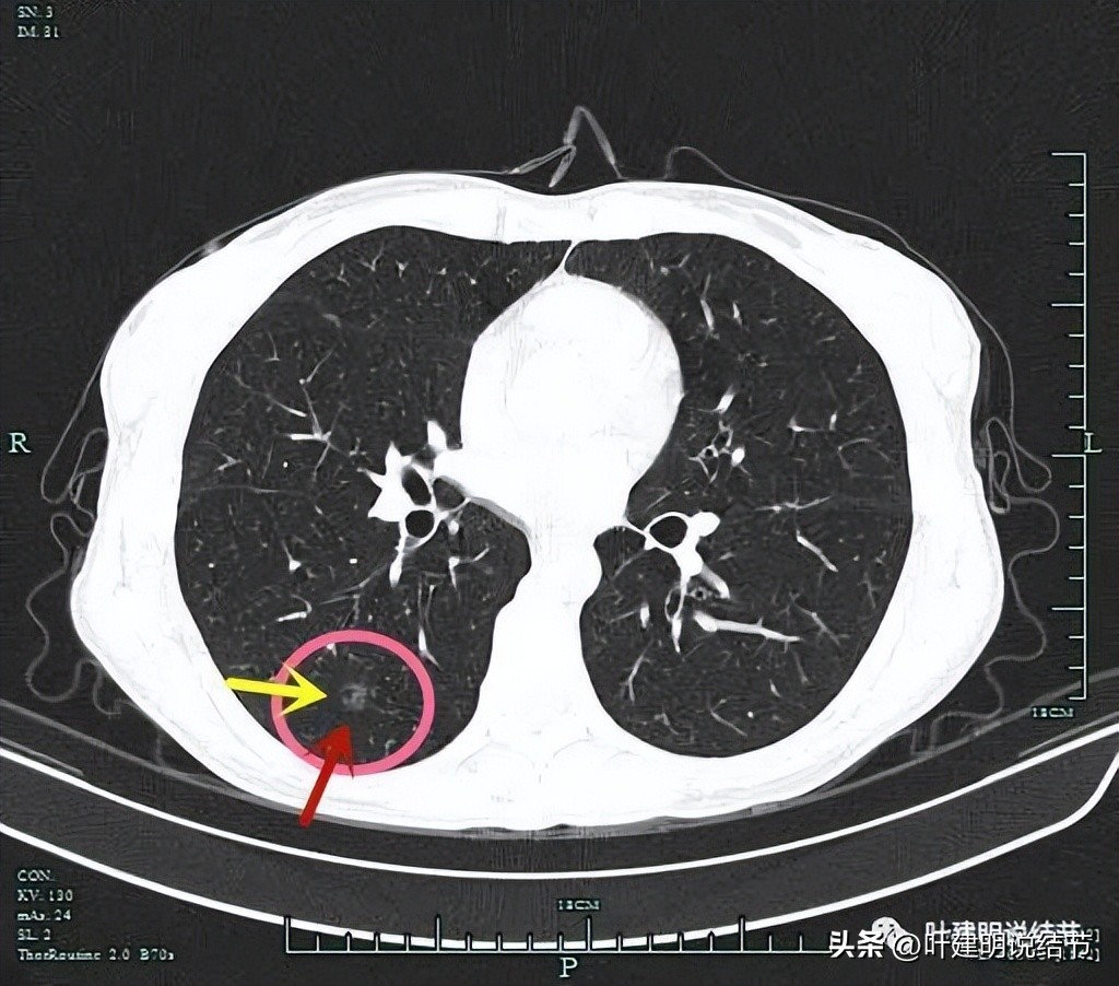 右下叶磨玻璃结节5*4,右下叶磨玻璃样结节多为炎性