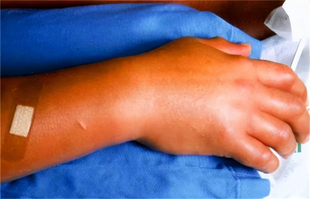 日本男子惨遭核辐射，83天亲眼看着自己被融化，离世时比凌迟还惨