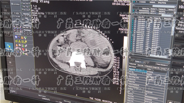 肠癌化疗后盆腔腹部出现积液,肠癌术后盆腔少量积液严重吗