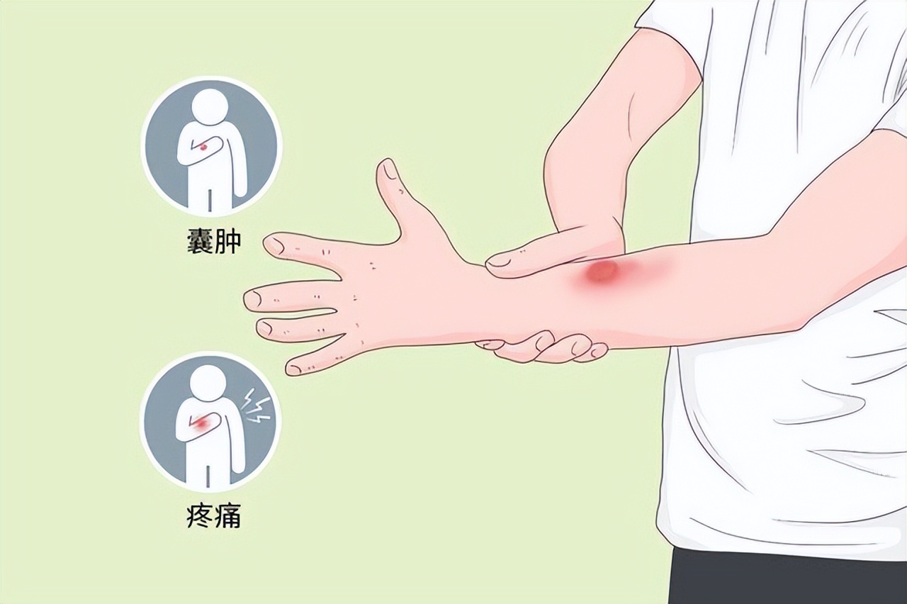 囊肿刚开始长有什么办法消除吗,囊肿有4个最简单自愈方法