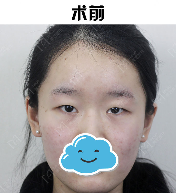 推荐一下哪家医院做双眼皮做得好,推荐双眼皮做得好的医生成都