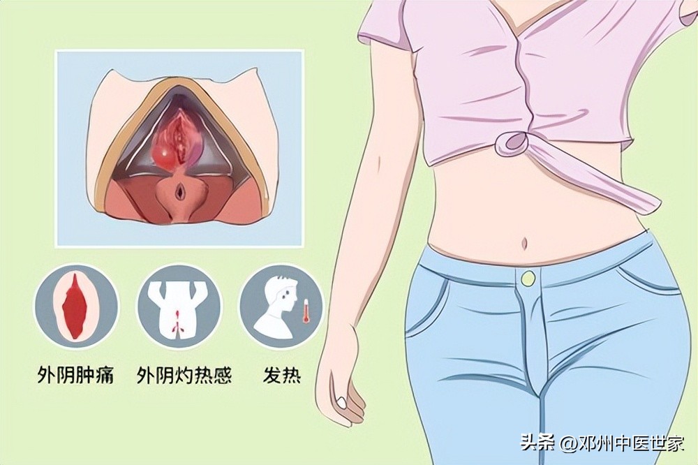 前庭大腺囊肿中药贴敷效果如何,治疗前庭大腺炎的药物