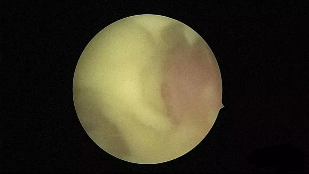 子宫里也会有脓？！这不是危言耸听，图文带你看懂