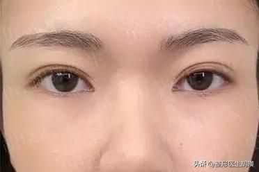 埋线双眼皮眼部淤青很厉害怎么办,埋线双眼皮没有那么明显了怎么办