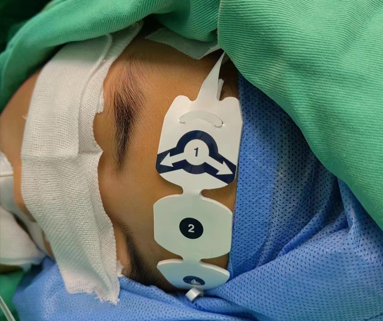 麻醉手段治疗睡眠障碍,手术麻醉会导致睡眠障碍吗